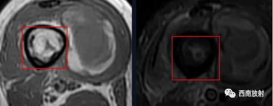 【病例】慢性骨髓炎1例X线CT及MR-15