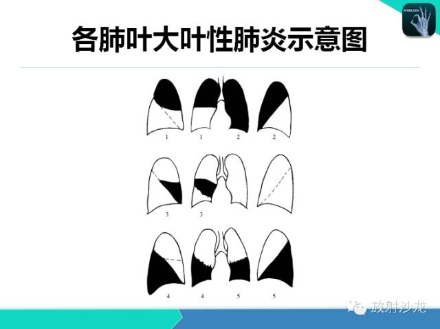 【PPT】肺炎的X线和CT表现