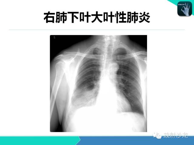 【PPT】肺炎的X线和CT表现
