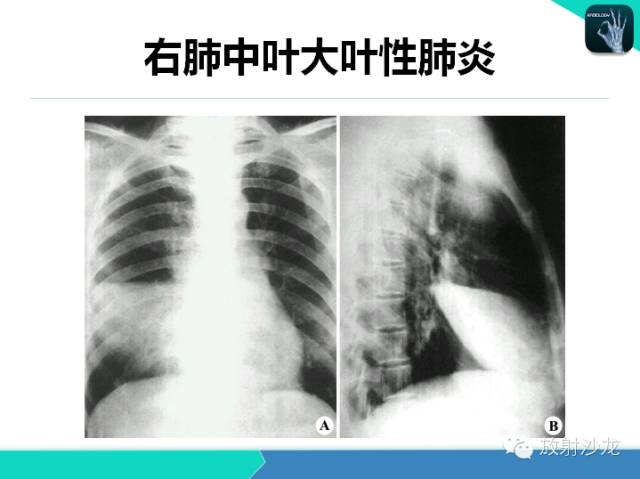 【PPT】肺炎的X线和CT表现