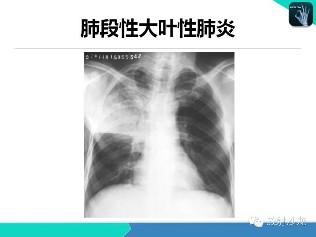 【PPT】肺炎的X线和CT表现
