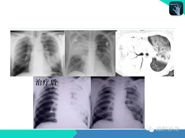 【PPT】肺炎的X线和CT表现