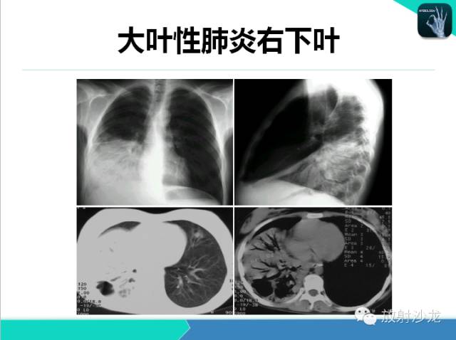 【PPT】肺炎的X线和CT表现