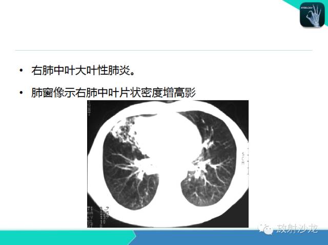 【PPT】肺炎的X线和CT表现