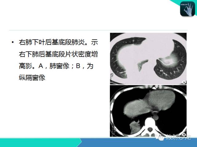 【PPT】肺炎的X线和CT表现
