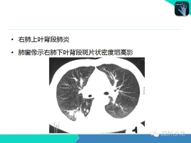 【PPT】肺炎的X线和CT表现