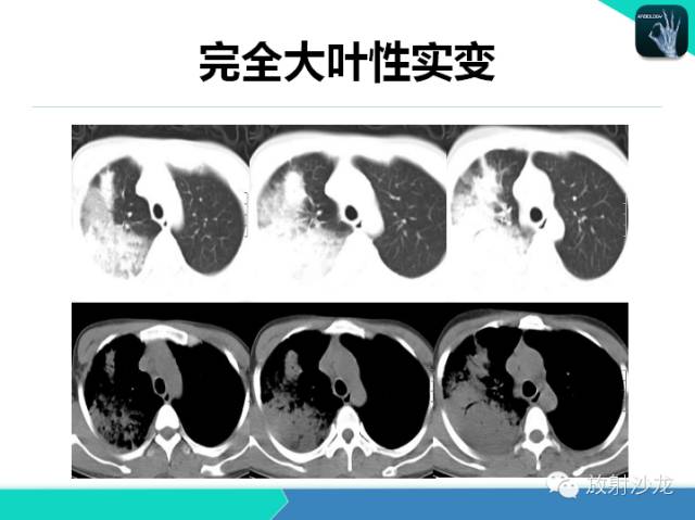 【PPT】肺炎的X线和CT表现