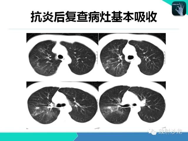【PPT】肺炎的X线和CT表现