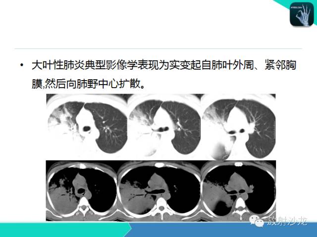 【PPT】肺炎的X线和CT表现
