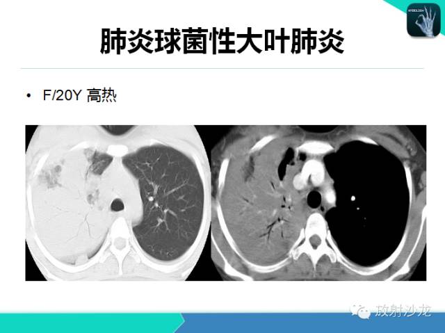 【PPT】肺炎的X线和CT表现