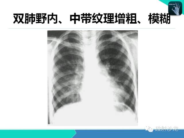 【PPT】肺炎的X线和CT表现