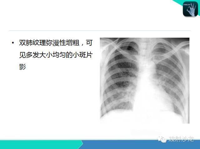 【PPT】肺炎的X线和CT表现