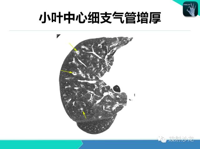 【PPT】肺炎的X线和CT表现