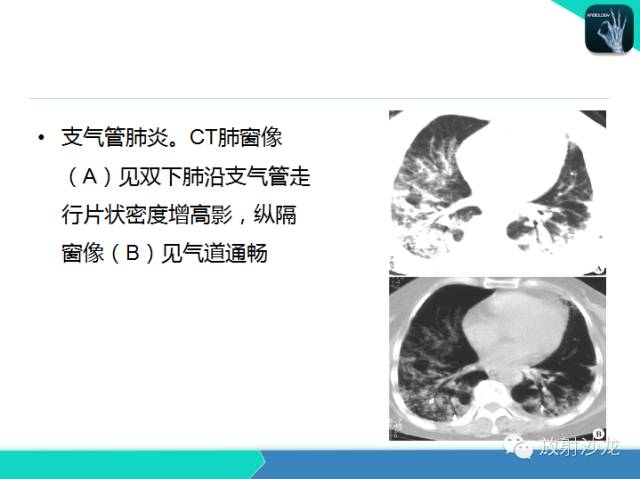 【PPT】肺炎的X线和CT表现