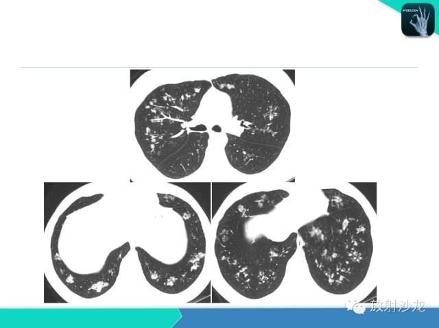 【PPT】肺炎的X线和CT表现