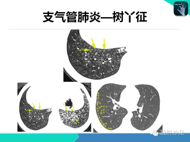 【PPT】肺炎的X线和CT表现