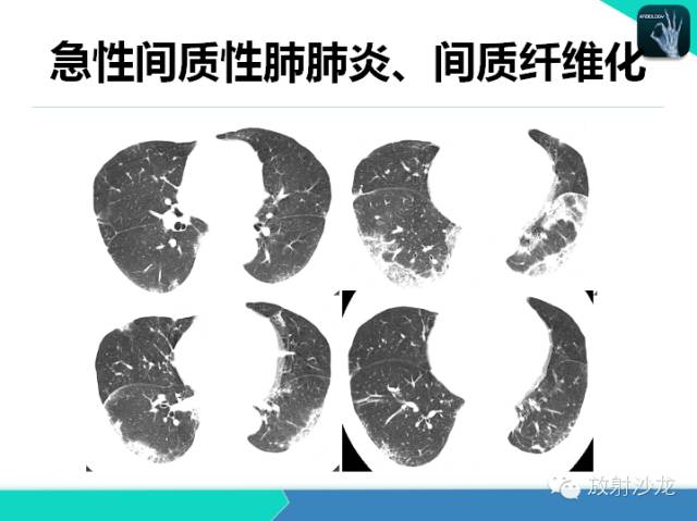 【PPT】肺炎的X线和CT表现