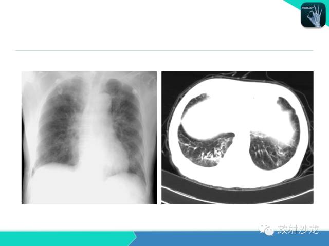 【PPT】肺炎的X线和CT表现