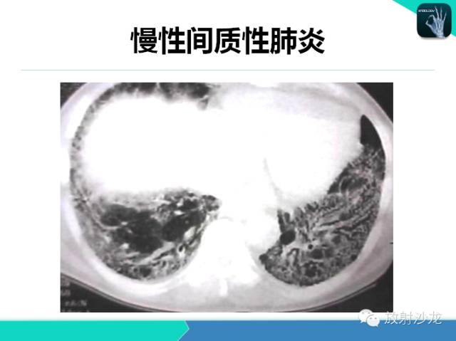 【PPT】肺炎的X线和CT表现