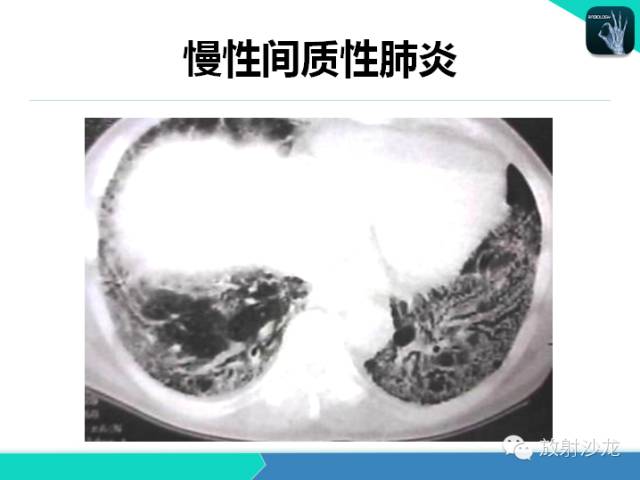 【PPT】肺炎的X线和CT表现