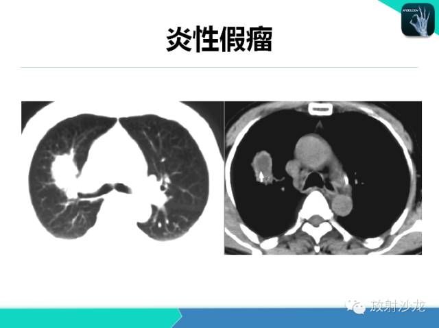 【PPT】肺炎的X线和CT表现
