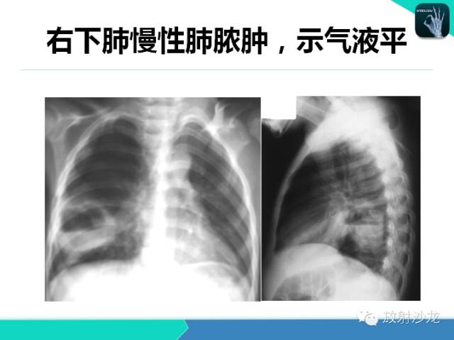 【PPT】肺炎的X线和CT表现