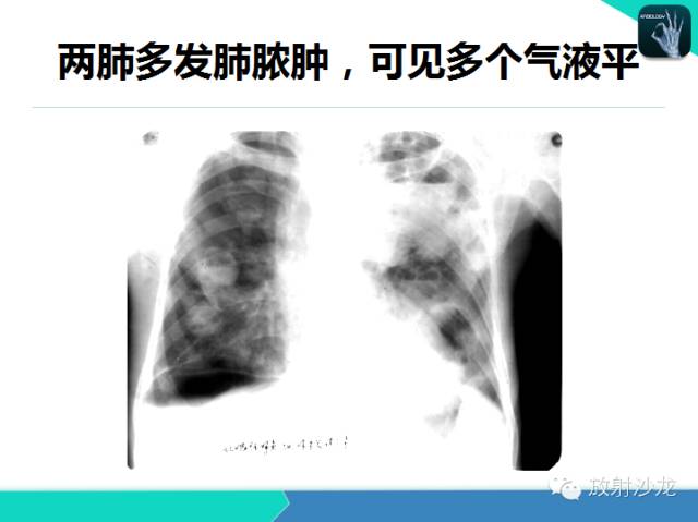 【PPT】肺炎的X线和CT表现