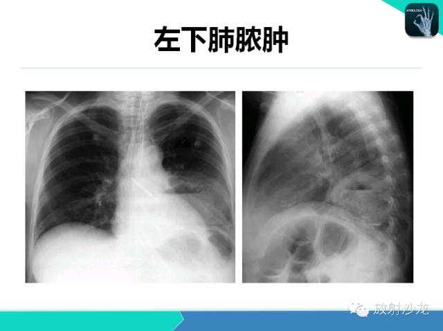 【PPT】肺炎的X线和CT表现