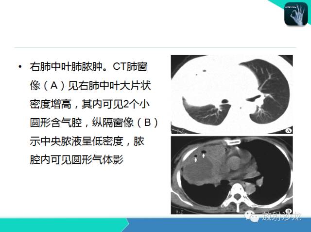 【PPT】肺炎的X线和CT表现