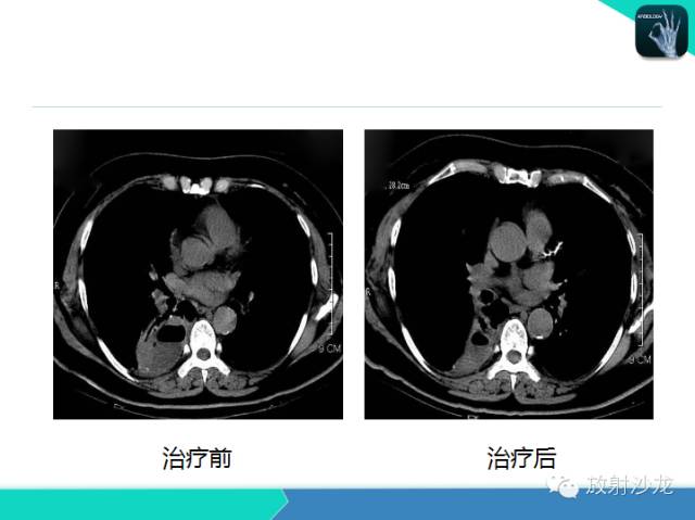 【PPT】肺炎的X线和CT表现