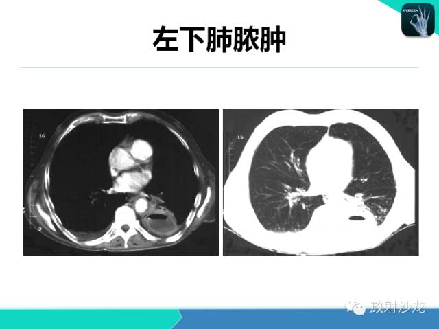【PPT】肺炎的X线和CT表现