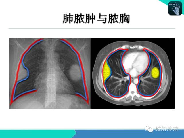 【PPT】肺炎的X线和CT表现
