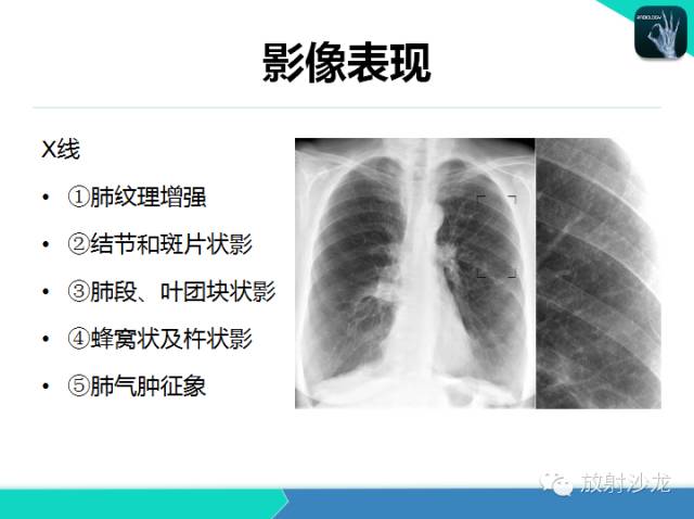 【PPT】肺炎的X线和CT表现