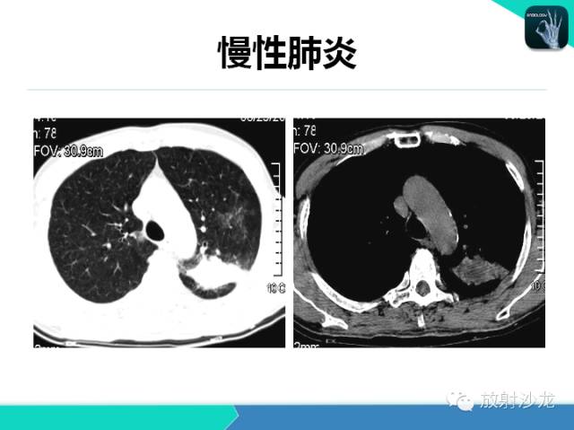 【PPT】肺炎的X线和CT表现