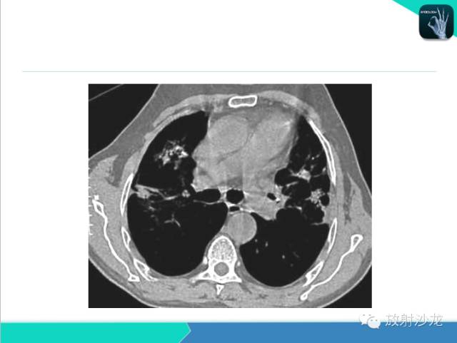 【PPT】肺炎的X线和CT表现