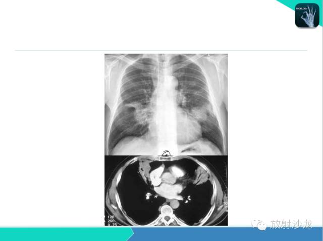 【PPT】肺炎的X线和CT表现