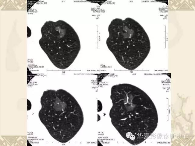【PPT】肺内磨玻璃样结节的影像诊断与处理对策