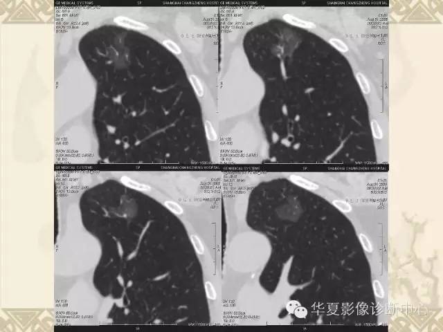 【PPT】肺内磨玻璃样结节的影像诊断与处理对策