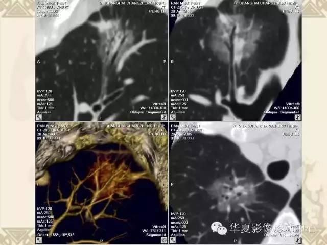 【PPT】肺内磨玻璃样结节的影像诊断与处理对策