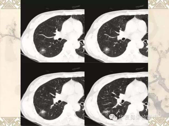【PPT】肺内磨玻璃样结节的影像诊断与处理对策