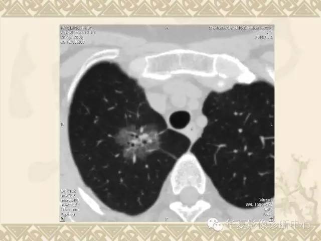 【PPT】肺内磨玻璃样结节的影像诊断与处理对策