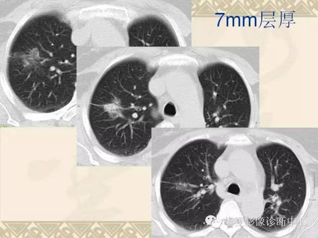 【PPT】肺内磨玻璃样结节的影像诊断与处理对策
