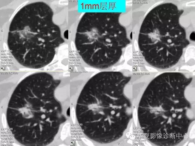 【PPT】肺内磨玻璃样结节的影像诊断与处理对策