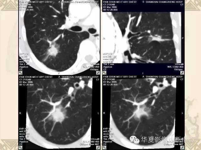【PPT】肺内磨玻璃样结节的影像诊断与处理对策