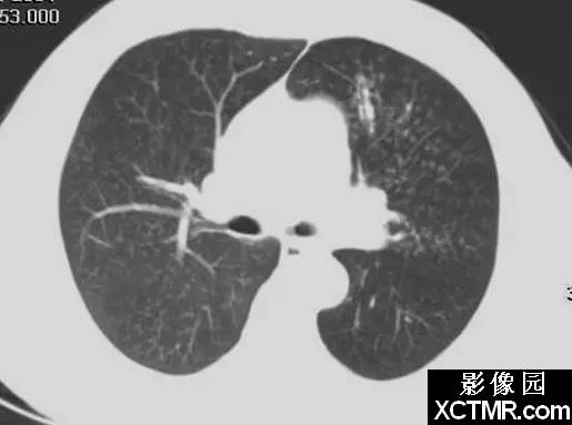 新月征、印戒征……盘点呼吸系统那些“听上去很美”的影像征象