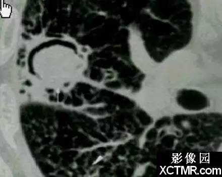 新月征、印戒征……盘点呼吸系统那些“听上去很美”的影像征象