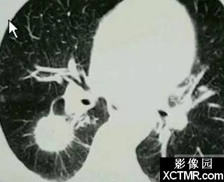 新月征、印戒征……盘点呼吸系统那些“听上去很美”的影像征象