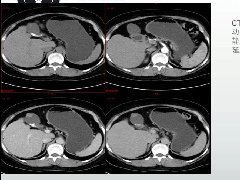 胆囊管状腺瘤1例CT及MR影像表现