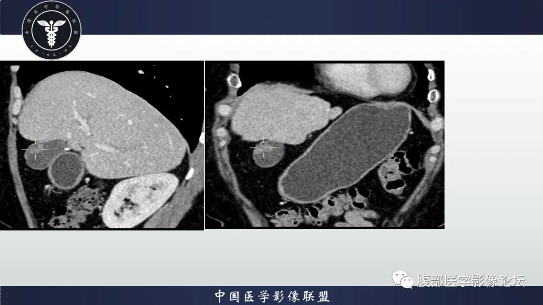 【病例】胆囊管状腺瘤1例CT及MR影像表现-4