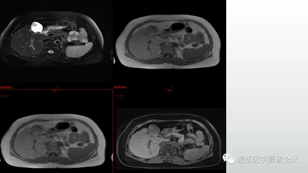 【病例】胆囊管状腺瘤1例CT及MR影像表现-5